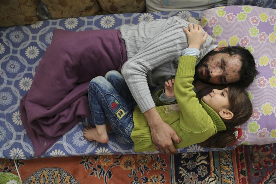 <p>Yaşam kategorisinde, Cem Genco'nun &ccedil;ektiği "G&ouml;zyaşı'nın babası i&ccedil;in &ccedil;ağrısı karşılık buldu" başlıklı fotoğraf birinci oldu. Fotoğrafta, Suriye'nin İdlip kentinde rejim birliklerine ait savaş u&ccedil;aklarından atılan varil bombası nedeniyle iki bacağını, sağ el parmaklarını, g&ouml;zlerini ve işitme yetisini kaybeden 27 yaşındaki Mamun Halid Nasır'a yardım eli uzatılmasının ardından, Nasır'ın 5 yaşındaki kızı G&ouml;zyaşı'nın mutluluğu objektife yansıyor. Cumhurbaşkanı Recep Tayyip Erdoğan'da yaşam kategorisinde bu fotoğrafı oylamıştı.</p>
