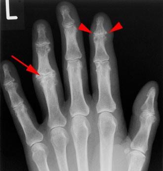 Osteoartrit:  Hükümet, bu hastalığın tedavisine yaklaşık 48 milyar dolar harcıyor. Yıllık artan harcama oranı yüzde 8. Kambur bel çizgisi artritlerin niçin maliyetinin arttığının bir sebebi olabilir. Obezite de artritler için büyük bir risk faktörü