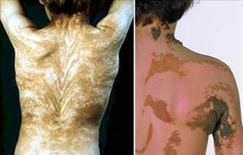 <p>8- Blaschko Çizgileri: Tüm vücuttaki ilginç çizgiler Blaschko çizgileri oldukça nadir görülür ve ilk olarak 1901′de Alman dermatolojist Alfred Blaschko tarafından sunulan açıklanamaz bir insan anatomisi fenomenidir.</p>