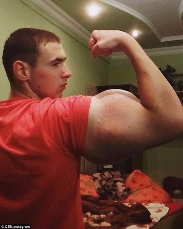 <p>21 yaşındaki Rus Kiril Tereshin, büyük pazılar ve üçgen vücudua sahip olmak için kaslarına tehlikeli kimyasal maddeler enjekte etti.</p>

