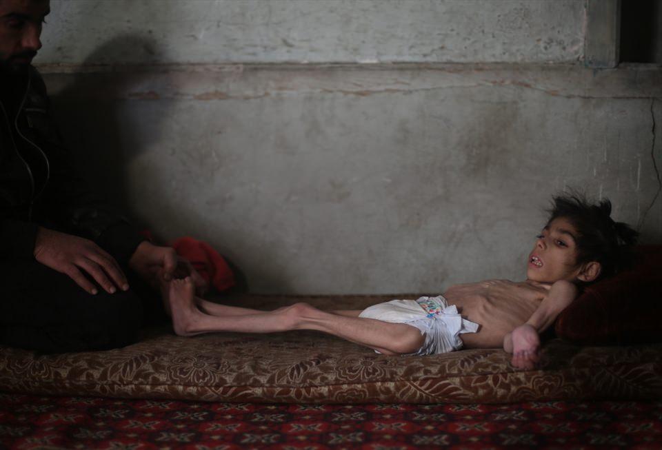 <p>Suriye'de Beşşar Esed rejiminin ablukasındaki Doğu Guta'da yaşayan 8 yaşındaki Ravan, 8 kilograma kadar düştü. Yetersiz beslenme ve ilaç bulamadığı için bir deri bir kemik kalan küçük kız, beyin felcinden siroza birçok hastalıkla mücadele ediyor.</p>
