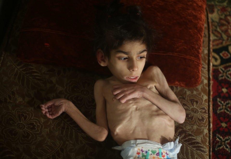 <p>Doğu Guta'nın Mida beldesinde yaşam mücadelesi veren 8 yaşında ve sadece 8 kilogram ağırlığındaki Ravan, yürüyemez ve konuşamaz duruma geldi.</p>

<p> </p>
