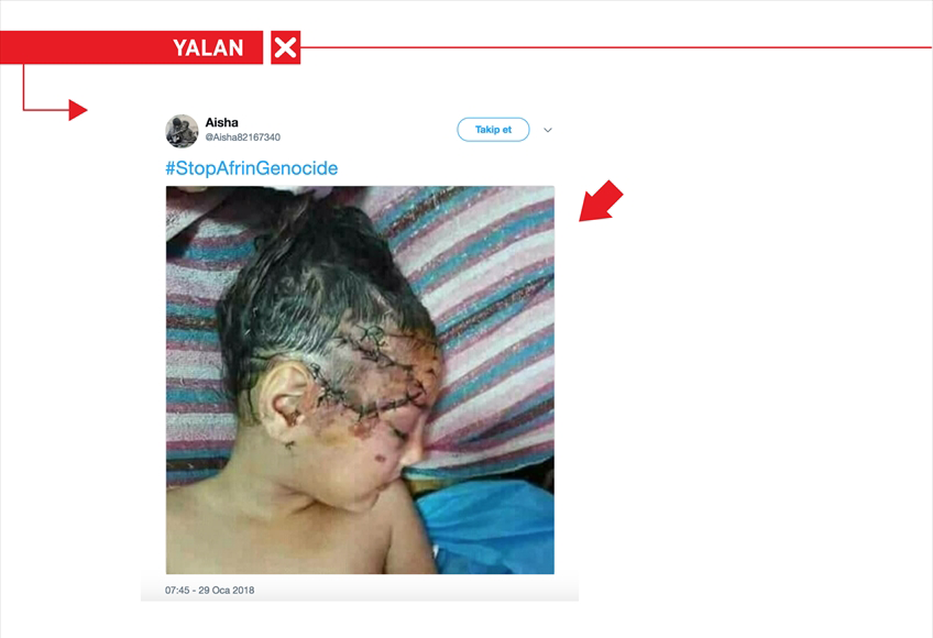 <p>Terör örgütü PYD/PKK'ya yakın sosyal medya hesapları, Türk Silahlı Kuvvetlerinin (TSK) Afrin'deki terör hedeflerine yönelik başlattığı Zeytin Dalı Harekatı'nı karalamak için "Afrin'de çok sayıda Türk askeri öldürüldü" iddiasıyla 2007'de şehit ettikleri sivil ve korucuların cenaze törenine ilişkin görseli paylaştı. "Afrin'de soykırımı durdurun" etiketiyle paylaşılan yaralı bir bebek görselinin, Irak'ta çekildiği ve internet ortamında 16 hafta önce paylaşıldığı tespit edildi.</p>
