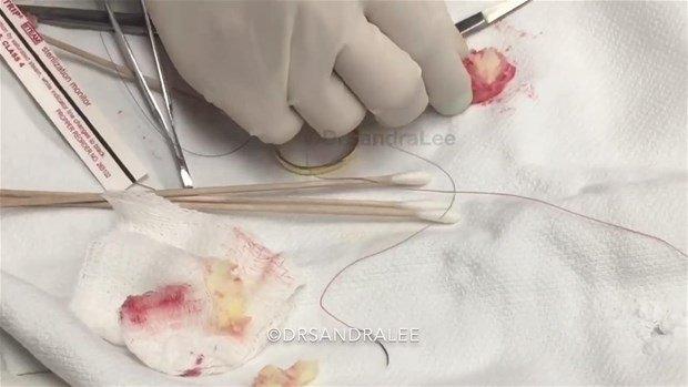 <div><strong>Kist göz kenarında çıkınca...</strong></div>
<div> </div>
<div>Epidermoid kist, sıklıkla yüz, boyun veya gövdede görülür, ancak vücudun herhangi bir yerinde de görülebilen iyi huylu bir kisttir. Bir diğer ismi ise Sebase Kist'tir fakat bu dermatologlar tarafından tercih edilmemektedir. </div>