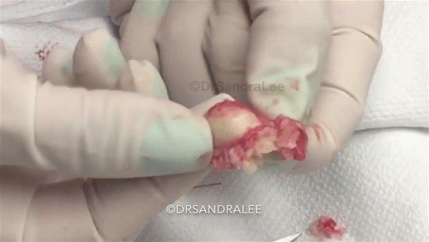 <div>Epidermoid kistler, deride yağ üreten hücrelerin kapalı alanda tıkanmasından kaynaklanır. Bezelerin içi peynire benzer yağlı sarı bir madde ile doludur.</div>
<div> </div>
