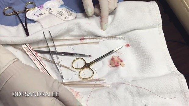 <div>Epidermoid kistin belirtileri olmayabilir ve genellikle zararsızdır. Genellikle insanlar, kisti görünümünü beğenmedikleri ya da kistin geçmişte koparılmış, iltihaplanmış veya "enfekte" olduğu için aldırmak isterler. </div>

<div> </div>
