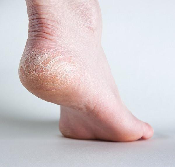 <p>Evde hazırlayacağınız pratik tariflerle topuklarınızdaki ölü derileri temizleyebilir, ayaklarınızı sağlıklı bir görünüme kavuşturabilirsiniz.</p>

<p>İşte sadece 3 malzeme ile yapılan topuk peelingi...</p>
