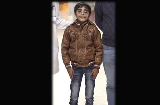 <p>Gözün kapanması ve göz protezinin düşmemesi için alt ve üst göz kapağına gerekli cerrahi müdahaleleri yaptık. Yaklaşık 6 saat süren bu operasyonla hem işlevsel hem de estetik görünüm açısından optimum sonuca ulaştık. Tüm bu operasyonlar sonucunda Ali'nin artık yediği yemeklerin burun ve gözünden geri gelmesini engelledik. Ayrıca kendi kendine düşen göz protezi sorunu da ortadan kalktığından artık protezini de son derece rahat ve konforlu şekilde kullanabiliyor."</p>
<p> </p>