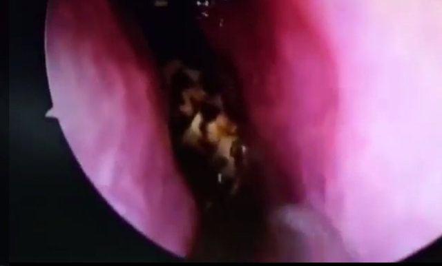 <p>Böceğin bir süre daha kadının kafatasında yaşaması durumunda hastanın hayatını kaybedebileceğini açıklayan Dr. Shankar, 45 dakikalık bir operasyonla kadının kafatasındaki hamam böceğini çıkardı.</p>
<p> </p>