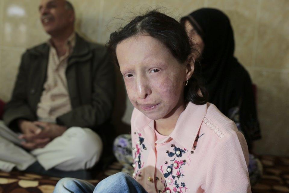 <p> Kızı henüz 2 aylıkken, yanaklarında kırmızı lekelerin çıkmaya başladığını ve hastaneye götürdüklerini, doktorların ciddi bir durum olmadığını söylemekle yetindiğini aktaran Hüseyin, "Ancak bir süre sonra vücudunda yaralar çıkmaya başladı.</p>