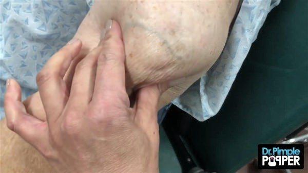 <p>Youtube'da Dr. Pimple Popper ismiyle  3,6 milyon takipçisi bulunan Dr. Sandra Lee yine ilginç bir operasyona imza attı.</p>

<p> </p>
