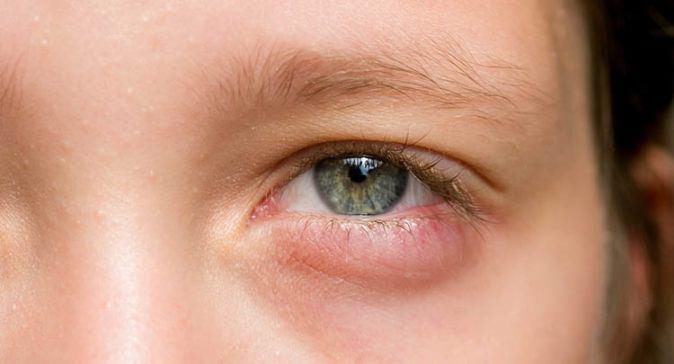<p>Göz şişmesi hemen hemen herkes de yaygın olarak görülen bir durumdur. Peki, göz şişmesi neden olur? İşte göz şişmesi hakkında bilinmeyenler...</p>
