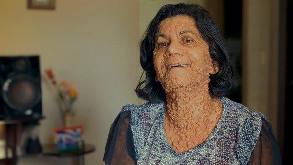 <p>Bu hastalık yüzünden vücudundaki kabarcıklıklarla yaşamayı öğrenen De Santos'un vücudu görünüşte ürkütse de mücadelesi takdire şayan. </p>

<p> </p>
