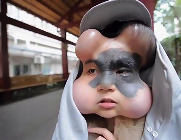 <p>Çin'de Xiao Yan'ın yüzündeki ölümcül lekenin çıkartılması için sıradışı bir teknik uygulandı! Yüzüne yumurta büyüklüğünde dört tane balon implant takılarak, cildi genişletildi ve leke alındı. </p>
<p> </p>