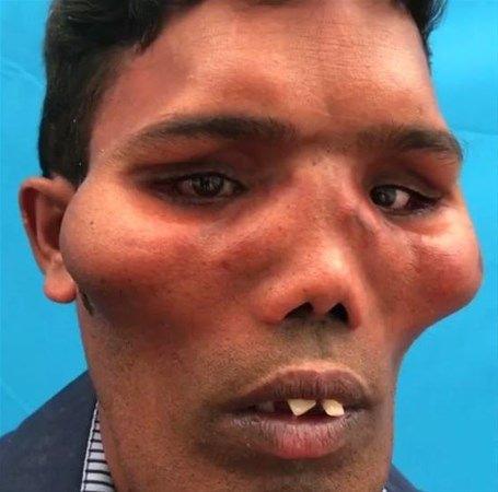 <p>Hindistanlı Suresh, 18 yaşından beridir Aslan Surat Sendromu'ndan muzdarip. Bu sendrom yüzünden dayanılmaz acılar çeken Suresh'e doktorlar yardım edememişti.</p>
