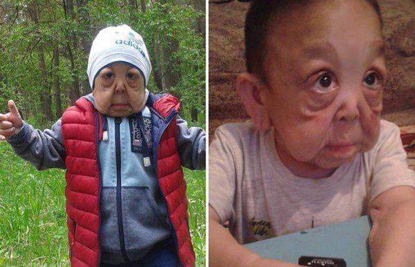 <p>Erken yaşlanma hastalığına yakalanan çocuk için doktorlar tedavi edilmesinin zor olduğunu fakat hayat kalitesini artırabileceklerini söylüyorlar.</p>
<p> </p>