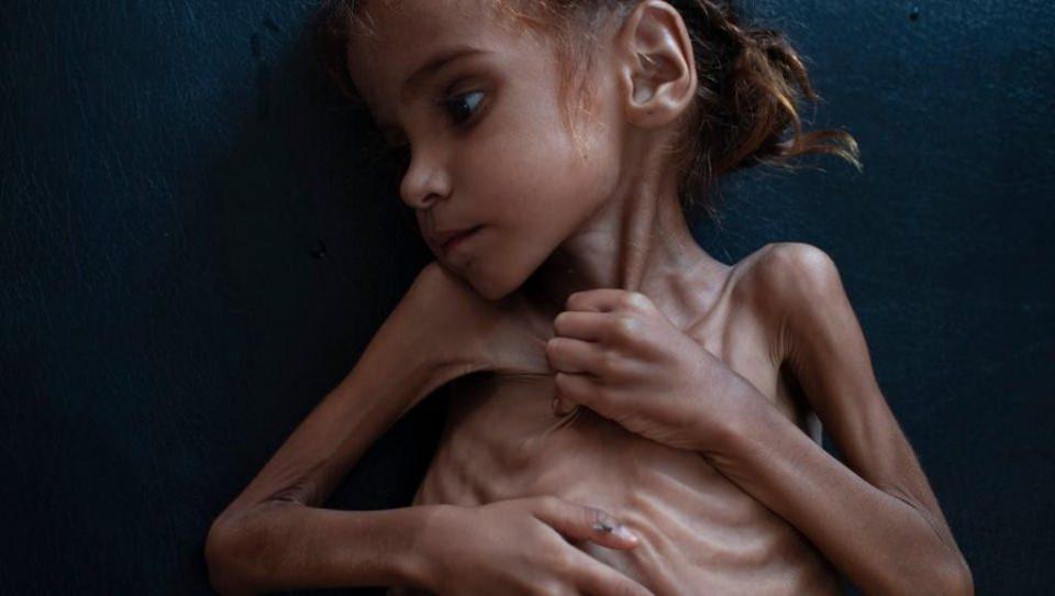 <p>Yemen’de iç savaşın sembolü olan ve geçtiğimiz hafta fotoğrafları yayınlanmasının ardından dünyanın gündemine oturan 7 yaşındaki Emel Hüseyin kaldığı kampta hayatını kaybetmişti. Ne yazık ki Yemen'de her 10 dakikada bir çocuk ölürken dünya bu konuda hala sessiz...</p>
