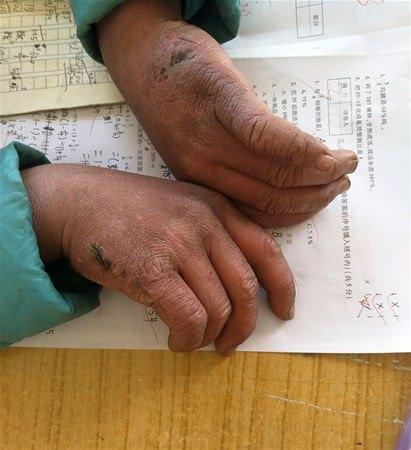 <p>Fuman okula vardığında saçları ve kaşları donmuştu. </p>
<p> </p>