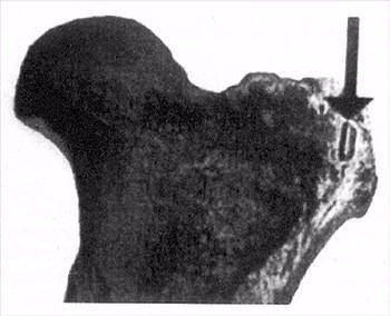 <p>Tarih öncesi devirlerde yaşamış olan Toxodon 'nun bulunan bir kalça kemiği. (Arjantin). Resimde ok ile gösterilen şey ise bir ok veya mızrak ucudur. İnsanın yaşamadığını sandığımız devirde , biri onu avlamış anlaşılan.</p>

<p> </p>
