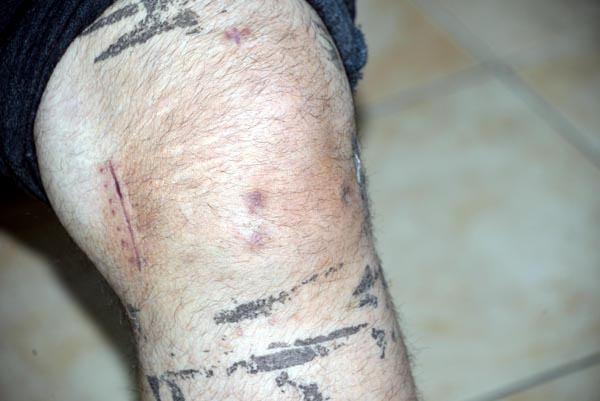 <p><strong>'AYLARDIR İŞE GİDEMİYORUM'</strong></p>
<p>Operasyon sonrası Diyarbakır'a dönen Özkan Durucan, menisküs ameliyatı sırasında dizinde tıbbi kamera parçası unutulduğu iddiasıyla doktor ve özel hastane hakkında suç duyurusunda bulunarak, dava açtı. Ağrılarının sürdüğünü belirten Durucan, "Menisküs ameliyatı sonrası bir türlü kendime gelemedim. Defalarca doktoruma gittim, 'Herhangi bir şey yok' diyerek beni yolladı. Batman'da çekilen röntgende bacağımda bir cisim tespit ettiler. Ben de araştırma yaparak, Adana'da özel bir hastanede ameliyat oldum. Bacağımda unutulan cismi çıkardılar. Cismin tıbbi kamera parçası olduğunu öğrendim. Halen işime gidemiyorum, ayağım aksıyor, yürüyemiyorum. Kendi özel ihtiyaçlarımı güçlükle yapıyorum. Aylardır çalışamıyorum. Benim bacağımda cisim unuttuklarını bilmelerine rağmen beni ameliyat etmediler. Ben de onlar hakkında suç duyurusunda bulundum, sonuna kadar hakkımı arayacağım" dedi.</p>