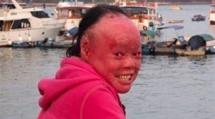 <p>Mui, liseye başladığında ise kâbusları başladı. Arkadaşları onunla sürekli dalga geçti. Ona ‘yaratık' gibi acımasız bir lakap taktılar. Okul çıkışı ise çocuğu hiç rahat bırakmadılar. İnternet aracılığıyla da dalga geçmeye devam ettiler. Maalesef 'Harlequin tipi iktiyozis' için herhangi bir tedavi yöntemi yok. Tek yapılabilecek olan şey çeşitli tedavilerle rahatsızlığın belirtilerini hafifletmek.</p>
<p> </p>