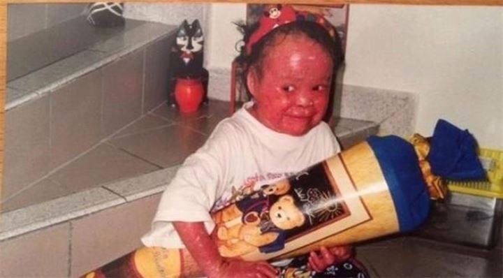 <p>CNN'in haberine göre; 2002 yılında Mui'ye Harlequin tipi iktiyozis teşhisi koyuldu. Ender rastlanan bu deri hastalığına sahip olan kişilerin ciltleri normalden 14 kat daha hızlı gelişiyor.</p>
<p> </p>