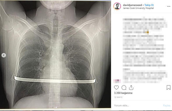<p>Göğüs tahtasına kavisli platin yerleştirilen David'in göğüs kafesinin her iki tarafı tel ve pimle birleştirildi.</p>

<p> </p>
