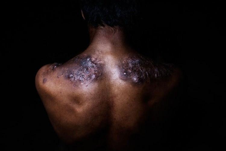 <p>Yaralı sırt, deforme olmuş belkemiği ve yamuk bacaklar madenciler arasında yaygın. Madencilerin &ccedil;oğu, k&uuml;k&uuml;rd&uuml; yanardağın kraterinden merkez kampa taşıdıkları fiziksel a&ccedil;ıdan yorucu &ccedil;aba sırasında dinlenmeye ve yeniden g&uuml;&ccedil; kazanmaya pek zaman ayırmıyor.</p>

<p>&nbsp;</p>
