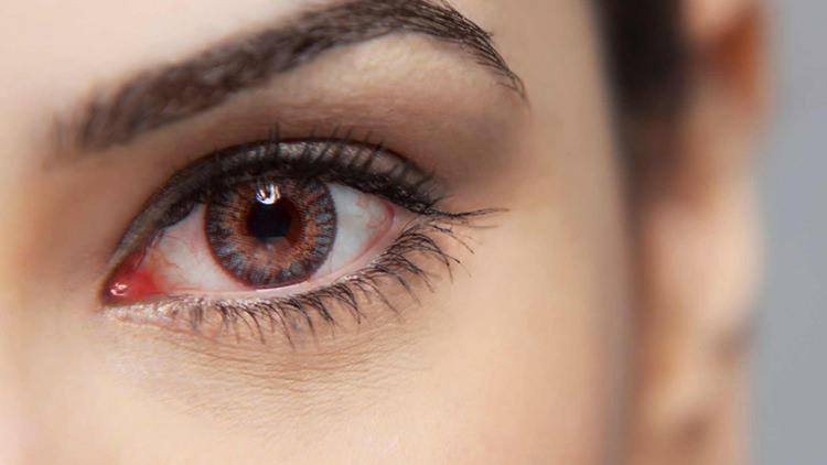 <p><span style="color:#B22222"><strong>GÖZ HASTALIKLARI</strong></span></p>

<p>Yüzdeki büütn organlar birbirindne çabuk etkilenir. O yüzden burun tıkanıklığı ağız sağlığını olumsuz etkilediği kadar göz sağlığını da etkiler. Özellikle göz kaslarını ve damarlarını zorlayan burun tıkanıklığı ileri zamanlarda göz içi kaşınma, kızarma v enfeksiyon kapma gibi sağlık sorunlarına nedne olur. </p>
