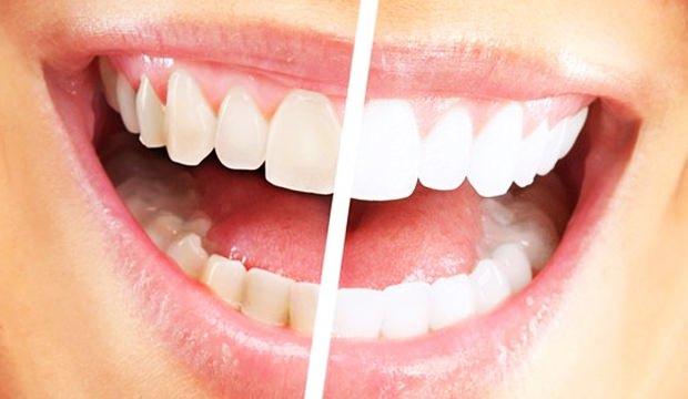 <p>Evde diş beyazlatmak sanıldığı kadar zor değil. Hemen hemen herkesin başlıca sorunlarından biri olan sararan dişlerden 7 günde kurtulmak mümkün. Peki diş nasıl beyazlar? İşte evde uygulayabileceğiniz yöntemle dişleri bembeyaz yapmanın yolları...</p>
