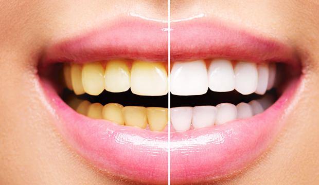 <p>Genetik nedenlerden dolayı diş sarılığı küçük yaştan itibaren görülebilir. İlerleyen yaşlarda mine tabakası aşınır ve dentin tabakasını sarı renge dönüştürür. Diş hekimliğinde kullanılan protez diş malzemeleri dişlere sarı bir renk verebilir. Kullanılan bazı ilaçlar özellikle gelişim çağındaki çocuklarda diş sarılığına yol açar.</p>

<p> </p>
