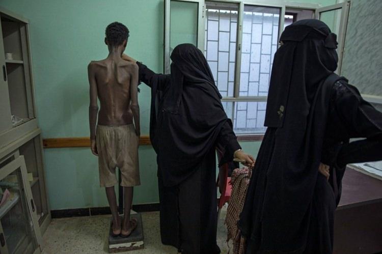 <p>Yemen'de 31 kiloya düşen 19 yaşındaki Etiyopyalı mülteci</p>
<p>Nariman El-Mofty</p>