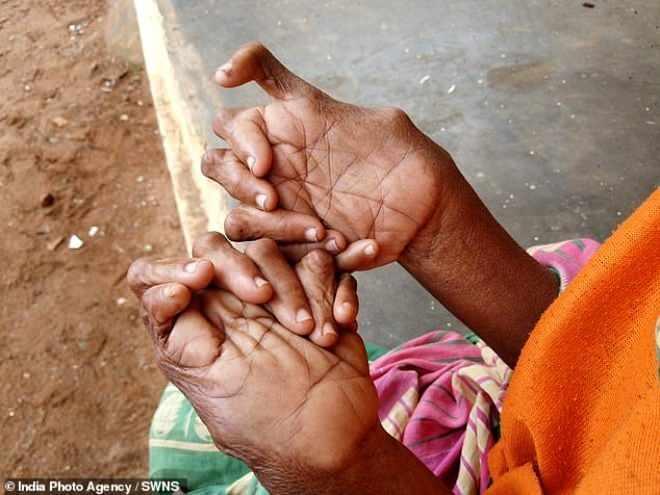 <p>Hindistan'da kalıtsal bir hastalıktan dolayı 31 parmaklı dünyaya gelen Kumari Nayak, toplum tarafından “cadı” ilan edilip, dışlandı.</p>

<p>Nadir görülen hastalıklardan biri olan polidaktili, kişinin yaşamını olumsuz etkiliyor. Hindistan'da bu hastalıktan muzdarip olan 63 yaşındaki Kumari Nayak da toplum trafından "cadı" ilan edilip, dışlandı.</p>
