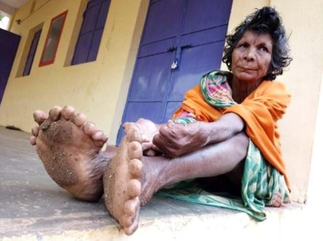 <p>Hindistan'da yaşayan 63 yaşındaki Kumari Nayak, polidaktiliden muzdarip. Nayak'ın el ve ayaklarında toplam 31 parmak bulunuyor.</p>
