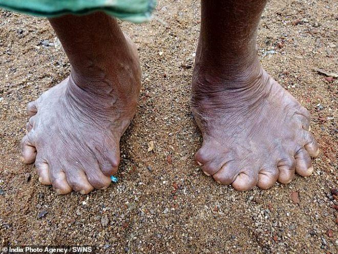 <p>19 ayak parmağı ve 12 el parmağı olan Nayak, dünyanın en çok parmağı olan insanı olarak Guinness Dünya Rekorları'na girdi. Önceki rekor sahibi, 14 ayak parmağı ve 14 el parmağı olan 47 yaşındaki Devendra Suthar'dı.</p>
