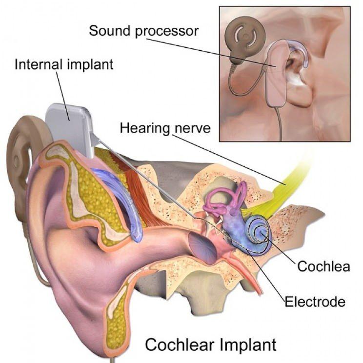 <p>Koklear implant: NASA mühendisi olan Adam Kissiah, 1970'lerin ortalarında koklear implantları geliştirdi. Buluşundan bu yana, doğumdan beri sağır olanlar da dahil olmak üzere 320.000'den fazla hastanın yaşamı,  düzeltici implantlar alınarak büyük ölçüde iyileştirilmiştir.</p>
