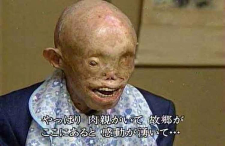 <p><strong>Hiroşima gazileri : ‘HIBAKUSHA’</strong><br />
<br />
Atom bombalarının patladığı anda Hiroşima ve Nagazaki kentlerinde bulunup hayatta kalan nükleer gazilere ‘hibakusha’ adının verilmesi kararlaştırıldı. Japon Hükümeti’nin 31 Mart 2007 tarihli araştırmasına göre bugün 250 bin ila 400 bin civarında hibakusha halen hayattadır.</p>