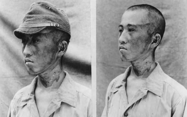 <p>Amerikan Milli Arşivi’nde bulunan bu fotoğrafta Japon askerinin patlama sonrasında yüzünün sol yanının yanmış olduğu görülüyor.</p>
<p> </p>