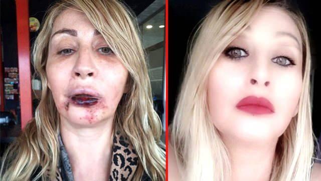 <p><span style="color:#800080"><strong>Antalya'da yaptırdığı estetik operasyonlar sonrasında alt dudağını kaybeden ve ağız içi dokularında çürüme meydana gelen kadın ilk kez konuştu. </strong></span></p>
