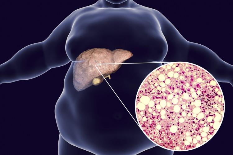 <p>1- Yağlı karaciğer safra taşına neden olur. Bu yüzden toksin atıcı besinler tüketmekte fayda var.</p>
