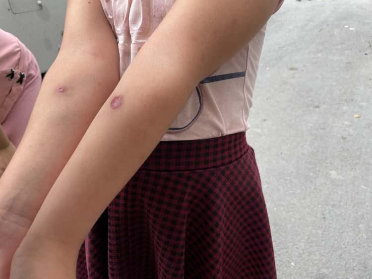 <p>İstanbul'un Avcılar  ilçesinde Yeşilkent Mahallesi sakinleri artan sivrisineklerin verdiği zarardan şikayetçi. Mahalle sakinleri, yakında bulunan dere nedeniyle arttığını belirttikleri sivrisineklerin soktuğu çocuklarda yaralar oluştuğunu öne sürdü. Çocukların bacakları ve kollarında sivrisineklerin sokması sonrası oluştuğunu ileri sürdükleri yaraları gösteren mahalle sakinleri, durumun çözümü için yetkililerden yardım bekliyor.</p>
