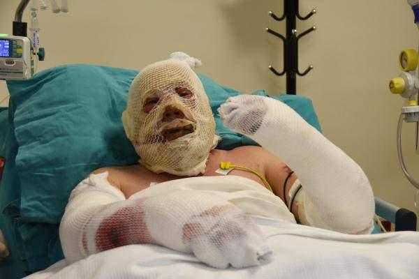 <p>Daha sonra arabayla Türlübey köyüne çıktık. Birkaç bardak su attılar üstüme. Apar topar ambulansa aldılar. Ambulansa aldıktan sonra Denizli'ye oradan da Eskişehir’e getirdiler. Sağ olsun Denizli Orman Müdürü'müz yardımcı oldu. Eskişehir Bölge Müdürü ile irtibata geçmişler. Eşim ve oğlum misafirhanedeler” dedi.</p>
