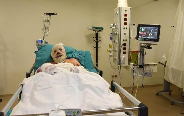 <p>‘YANIK ORANI YÜZDE 40, 2 KEZ AMELİYAT GEÇİRDİ’</p>
<p>Eskişehir Şehir Hastanesi Yanık Tedavi Merkezi sorumlusu Dr. Bülent Çağlar Bilgin de orman muhafaza memuru Yaşar Kozakbaş’ın tedavisinin iyiye gittiğini söyledi. Alevlerin arasında kaldığı için ciddi yanıkları olduğunu kaydeden Dr. Bilgin, “Denizli Buldan'daki orman yangınına müdahale eden bir hastamız. Görev başındayken dumana ve aleve maruz kalan bir hastamız. Önce Denizli Buldan'a, Oradan Denizli'ye, daha sonra da Eskişehir'e sevk edildi. Geldiği gece hastaya ilk cerrahi müdahalesini yaptık sonrasında 2 kez daha ameliyat ettik.</p>
