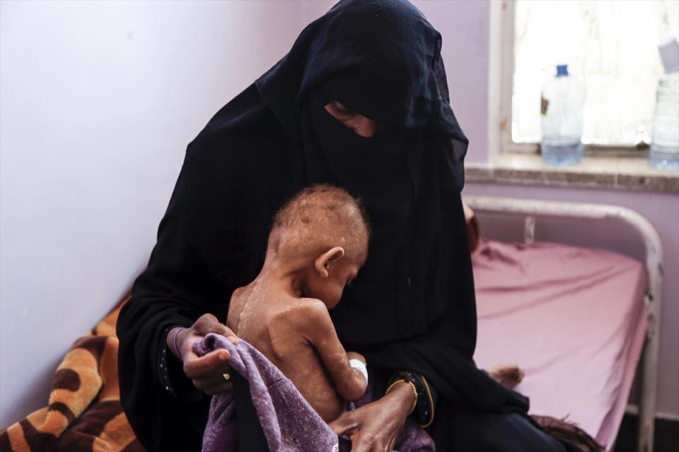 <p>Birleşmiş Milletler (BM), insani krizin yaşandığı Yemen`de bu yıl içinde 5 yaşın altındaki 400 bin çocuğun açlıktan ölme tehlikesiyle karşı karşıya olduğunu bildirdi. Yemen`in başkenti Sana`da, yetersiz beslenme nedeniyle zayıf düşen çocuklar, Al Sabeen Hastanesi`nde tedavi ediliyor.<br />
<br />
<strong>Foto Muhabiri Mohammed Hamoud</strong></p>
