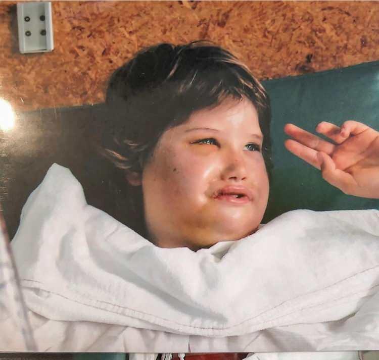 <p><strong>Doğuştan 4 milyonda bir nadir görülen bir durum nedeniyle gülümseyemeyen Tayla Clement, 12 yaşındayken donmuş yüzlü Clement, doktorların gülümsemesini geri kazanmak için uyluğundan yüzüne yumuşak doku naklettikleri bir "gülümseme ameliyatı" geçirdi.</strong></p>

