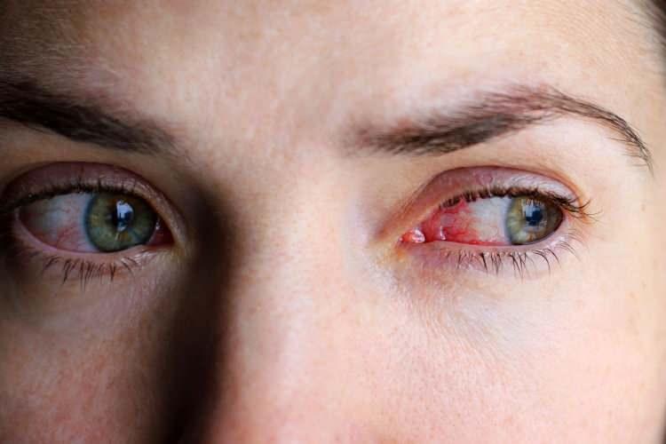 <p><strong>Yaklaşık 2 yıldır süren koronavirüs önlemlerinde neredeyse hiç görülmeyen adenovirüs, son günlerde artan tedbirsizlikler nedeniyle ciddi bir yükselişe geçti. Bulaşıcı olan adenovirüs, göz kuruluğuyla başlar. Daha sonra göz kaşıntısı, gözlerden yanmalı sulanma, göz kapağında ağırlık gibi belirtilerde seyretmeye devam eder. </strong></p>

