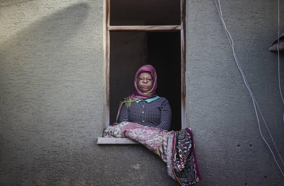 <p>3-4 ay sonra babasını görünce yanıklarını unuttuğunu dile getiren Emine İsmail, "Okula gitmek istiyorum ama bu halde değil, ameliyattan sonra gitmek, arkadaşlarımla gezmek dolaşmak istiyorum.</p>