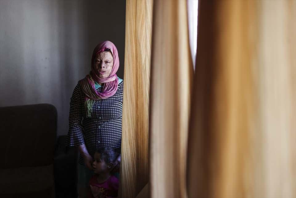 <p>Bu anlamda da derneğimizdeki profesör doktorlarımız, plastik cerrahlarımız ve diğer gönüllülerimizle gece gündüz çalışıyoruz." dedi.</p>
<p> </p>