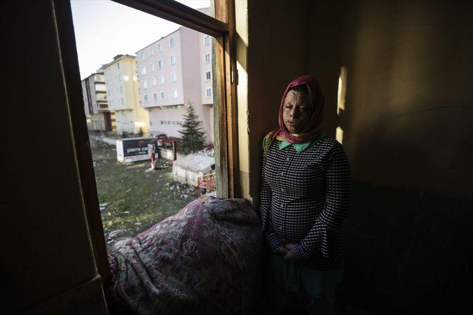 <p>Kahramankazan'da kaynakçı olarak çalışan üç çocuk babası Yusuf İsmail ise kızının Türkiye'deki ilk tedavisinin ardından Ayşegül Aksu ile tanıştıklarını anlatarak, "Onun yardımıyla Emine ameliyatlar oldu. </p>