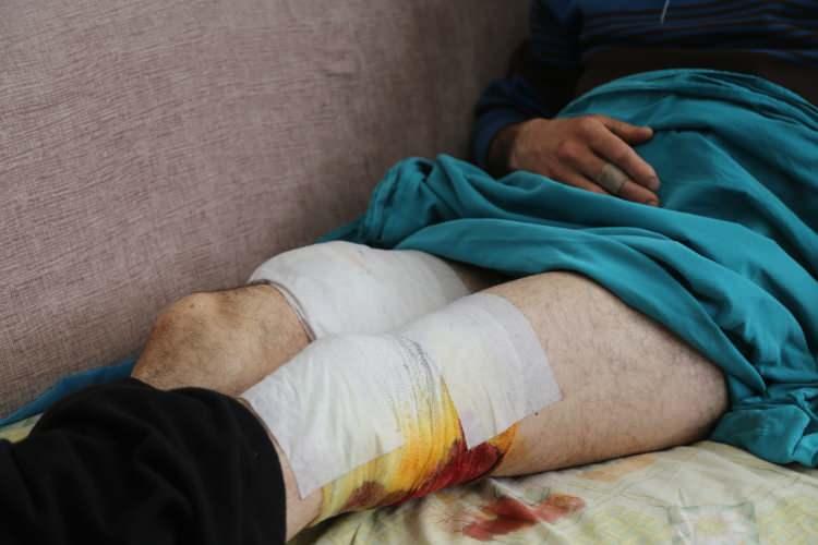 <p>Ayı saldırısı sonrası yaralı halde ormanlık alanda kalan Karadeniz, konuşamadığı için cep telefonuyla arkadaşını görüntülü arayarak yardım istedi. İlk tedavisi Borçka Devlet Hastanesinde yapılan Karadeniz, daha sonra Artvin Devlet Hastanesine sevk edildi. İki bacağından ağır yaraları olan Karadeniz tedavisinin ardından taburcu edildi.</p>

<p> </p>
